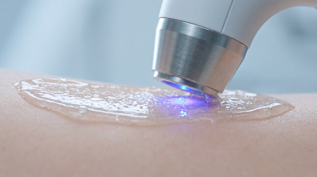 Macro close-up of professional aesthetic laser treatment on human skin with blue light and cooling gel, medical cosmetology procedure