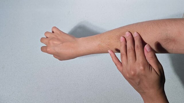 hand applies ointment to a bruise on the other hand, skin and injury care, dermatology and medicine
