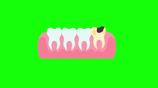 Animation of toothache with gums on green screen background. There are holes and yellow teeth. The concept of maintaining dental hygiene.