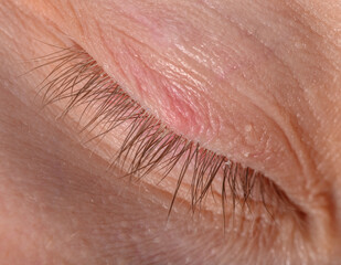 Fototapeta premium Red eyelid, pink spot on closed eyelid