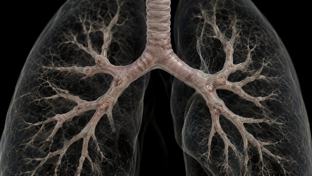 Bronchial Wall Thickening with Thin Mucus Film, Mild Luminal Narrowing, Realistic 3D Airway Anatomy, Medical Render, Natural Clinical Background