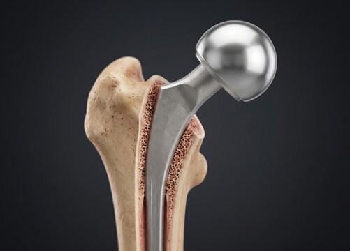 Hip prosthesis implanted in proximal femur, showing hemiarthroplasty with metallic femoral head and stem, anatomical bone structure with cortical and cancellous layers, generative ai illustration