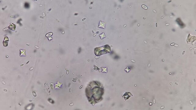Footage of Calcium oxalate monohydrate in urine under microscope.