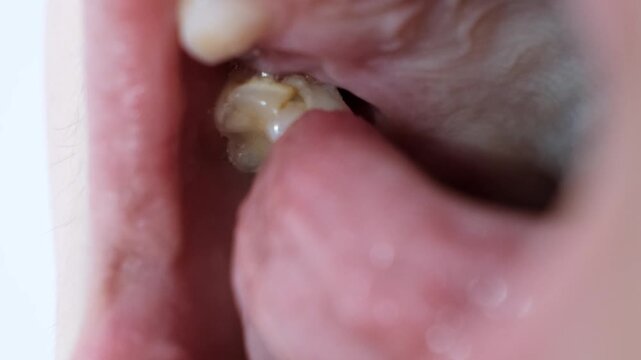 Child moves a milk loose tooth and presses on it with a tongue. Open mouth of a caucasian 9 year old kid. Posterior upper tooth remove. Changing teeth. Healthcare. Body part. High quality 4k footage.