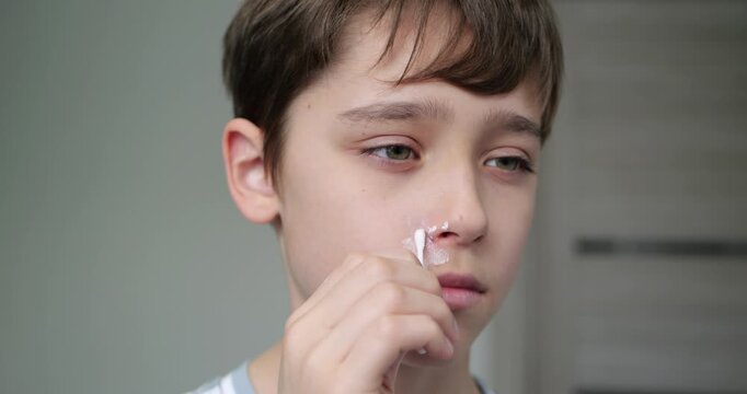 Young boy carefully applying medicated ointment with cotton swab to irritated skin under nose at home. Child treating redness after cold or runny nose. Healthcare and hygiene concept. Dermatitis