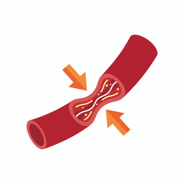 This image depicts a constricted blood vessel, illustrating the important concept of blood flow restriction in the human body highlighting health and circulation issues.