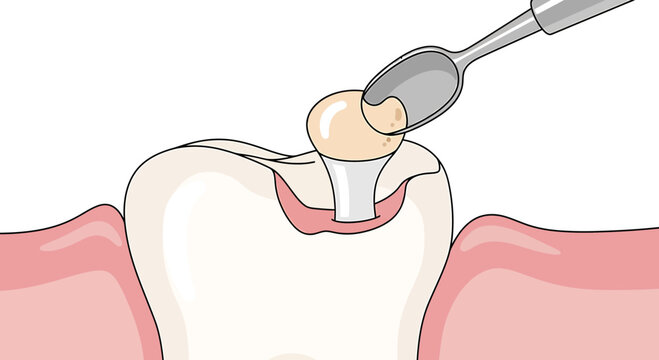 Dental filling procedure: applying composite resin to a prepared tooth cavity