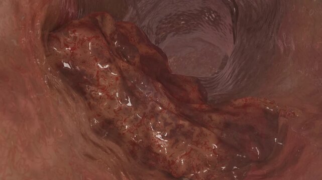 3D Medical Animation of Colon Cancer Inside Large Intestine