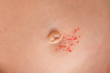 Fototapeta premium Close-up of an infant's skin showing a small hemangioma (vascular birthmark) on the body, soft lighting, gentle and clinical feel.