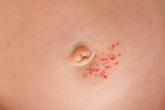 Close-up of an infant's skin showing a small hemangioma (vascular birthmark) on the body, soft lighting, gentle and clinical feel.