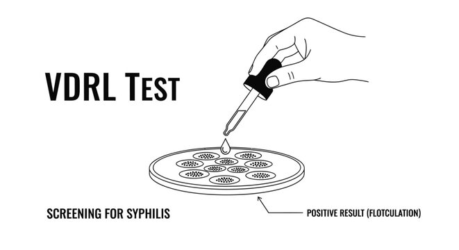 VDRL test for syphilis screening medical illustration with pipette and positive flocculation result