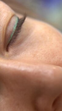 Close-up of CO2 Laser Treatment for Skin Pigmentation or Lesion Removal Near Eye Professional Dermatologist Performing Precise Laser Surgery on Senior Patient Face in Medical Clinic