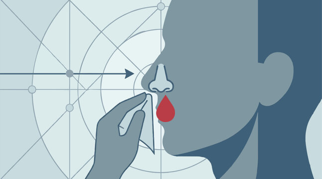 Epistaxis Nosebleed Illustration