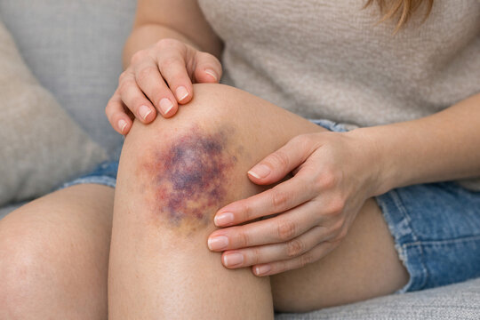 A female hand holding a leg with a purple and blue bruise on the kneecap