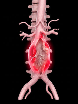 Ruptured abdominal aortic aneurysm with internal damage and inflammation, highlighted with red glow, next to lumbar spine and renal arteries on a black background