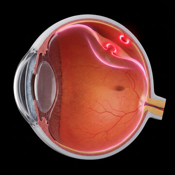 Detailed 3D rendering of a human eye cross-section with retinal detachment, highlighting the separation and tears with a bright red glow on a black background.