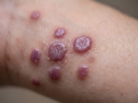 close-up of skin with multiple raised purple lichen planus lesions on arm
