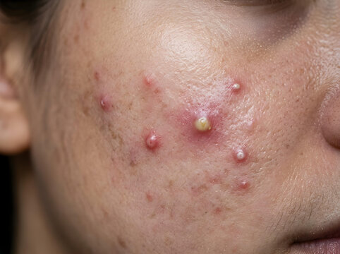 closeup of acne vulgaris on human cheek with inflamed red pustules and papules