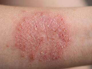 Fototapeta premium close-up of red inflamed skin rash dermatitis on human arm medical condition