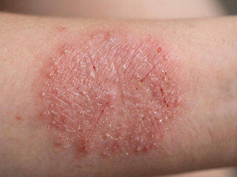 close-up of red inflamed skin rash dermatitis on human arm medical condition