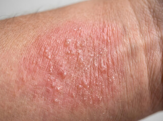 Fototapeta premium close-up of irritated skin with mild dermatitis on human arm