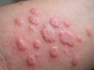 Fototapeta premium close-up of skin with red itchy hives and allergic reaction on human body