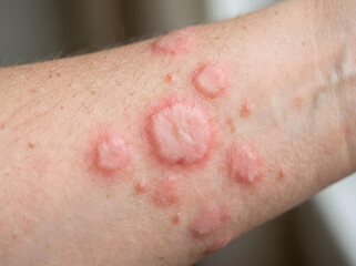 Fototapeta premium closeup of skin with urticaria hives rash on human arm medical condition