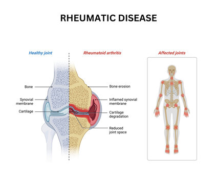 Rheumatic Disease Autoimmune Joint Inflammation