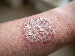 Fototapeta premium close-up of psoriasis skin condition on human arm with red scaly patches