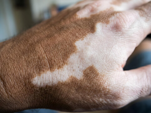close-up of human hand with vitiligo skin condition in soft natural light