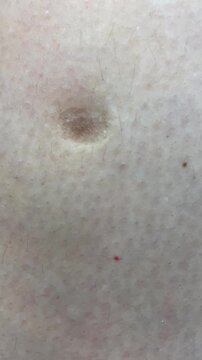 A close look at a small mark on skin shows changes in color and appearance over time in a light setting