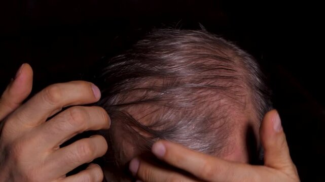 The man, whose hair is falling out and who has wounds on his head, is checking his hair.
