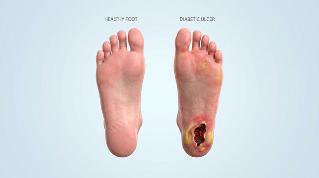 Diabetic Foot Ulcer Medical Illustration Healthy vs Infected Sole Anatomy
