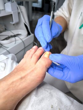Procedure for Podological Cleaning of a Patient's Toenail