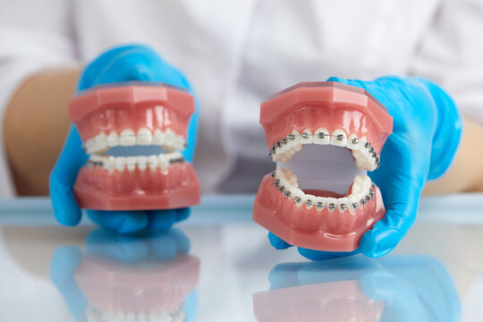 Orthodontist showing model of human jaw with wire braces and aligners explaining the difference