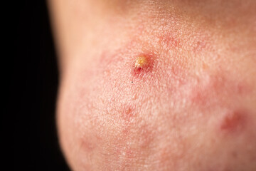 Fototapeta premium Acne skin pimple. Skin problem with pimple bumps. Irritated pimple texture. Close up pimple issue.