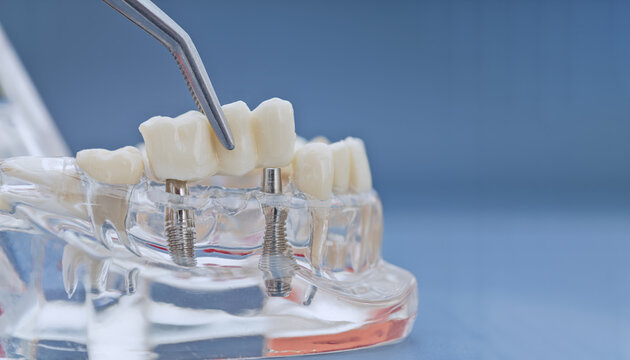 Dental bridge placement on implants concept. Transparent jaw model with tweezers and copy space for text.