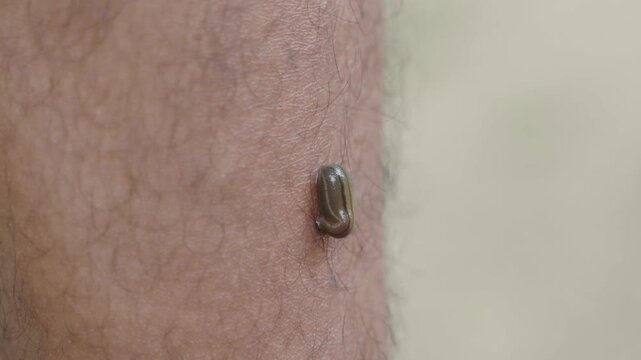 A leech has latched onto a person.