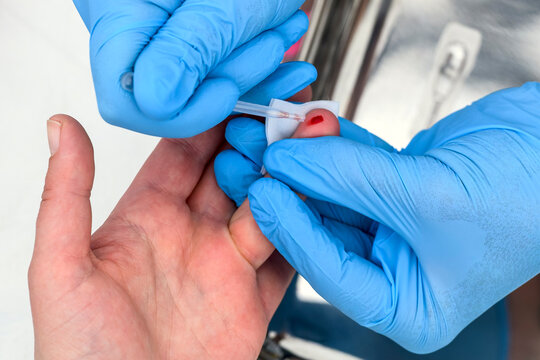 Close-up of a healthcare worker in blue nitrile gloves collecting a capillary blood sample from a patient's fingertip using a glass capillary tube for medical testing and diagnostics.