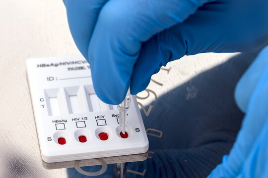 Medical professional in blue nitrile gloves applying blood samples to a rapid multi-panel diagnostic test cassette for HIV, Hepatitis B, Hepatitis C, and Syphilis screening.