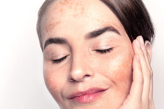 Caucasian woman face with pigmentation, melasma, freckles, age spots photo on white skin problem