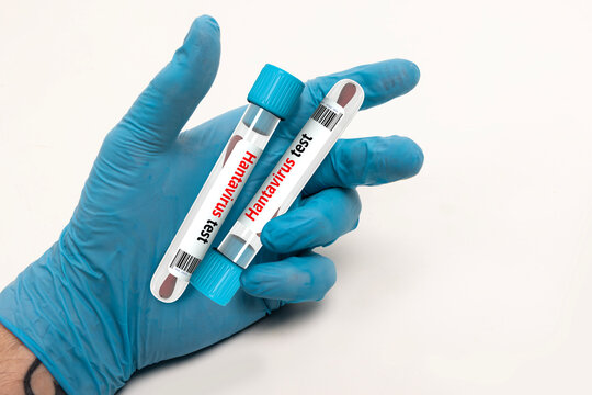 Hand in Blue Glove Holding Hantavirus Test Tubes with Cotton Swabs