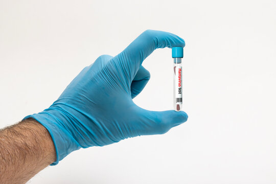 Hand in Blue Glove Holding Hantavirus Test Tube with Cotton Swabs