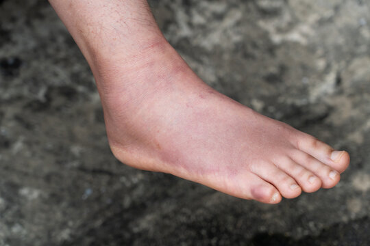 Swollen Foot After Cast Removal of Metatarsal Fracture
