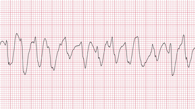 Ventricular Tachycardia Heart Rate ECG Monitor Medical Illustration Graphic Design