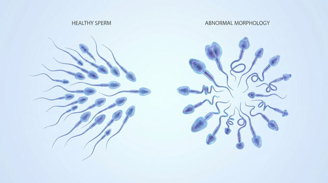 Healthy Sperm Cells and Abnormal Sperm Morphology Comparison Diagram