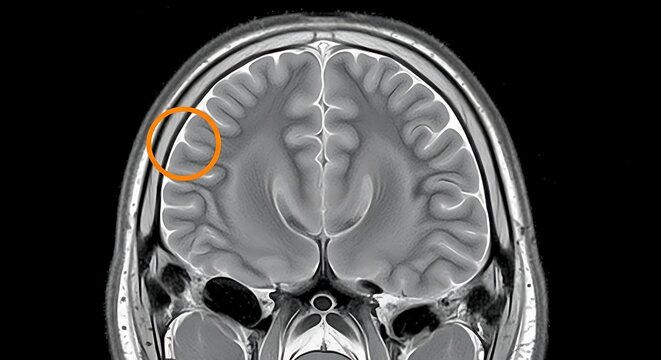 Coronal MRI scan of human brain with orange highlight on cerebral cortex