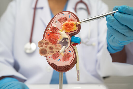 Chronic kidney disease, doctor with model for treatment urinary system, urology, Estimated glomerular filtration rate eGFR.