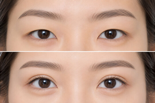 Before and After Eye Lift: A direct comparison of two different eye appearances highlighting cosmetic enhancements, perfect for medical or beauty related content.