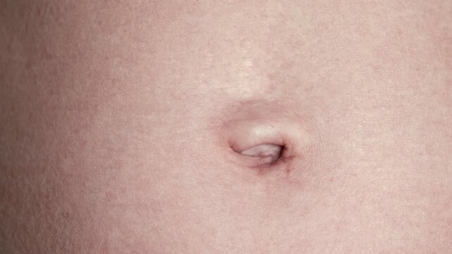 Navel close-up front view. A woman's stomach after pregnancy with stretch marks on the skin. A scar after laparoscopic surgery through the navel. Body part. Postoperative lymphatic edema on a abdomen.